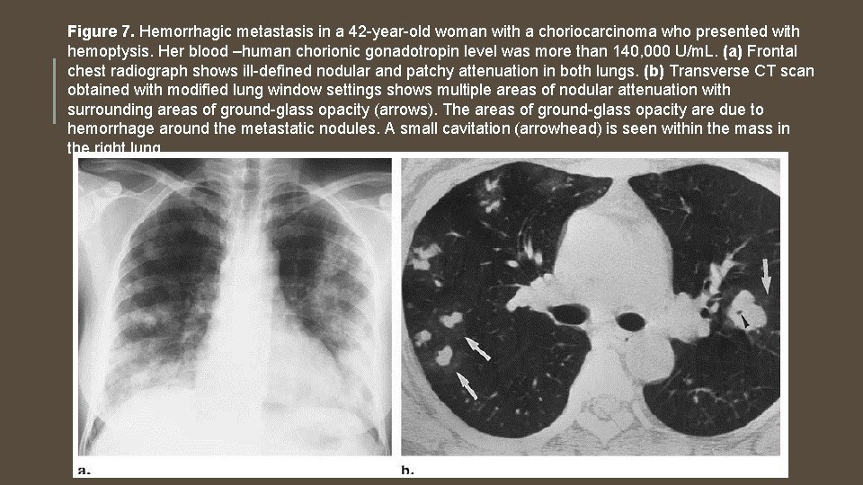 Figure 7. Hemorrhagic metastasis in a 42 -year-old woman with a choriocarcinoma who presented