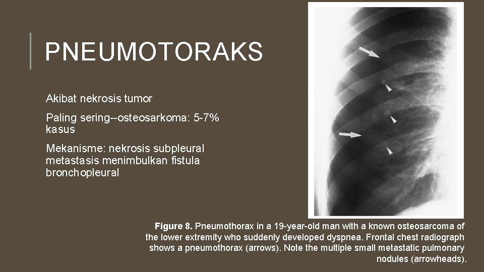 PNEUMOTORAKS Akibat nekrosis tumor Paling sering--osteosarkoma: 5 -7% kasus Mekanisme: nekrosis subpleural metastasis menimbulkan