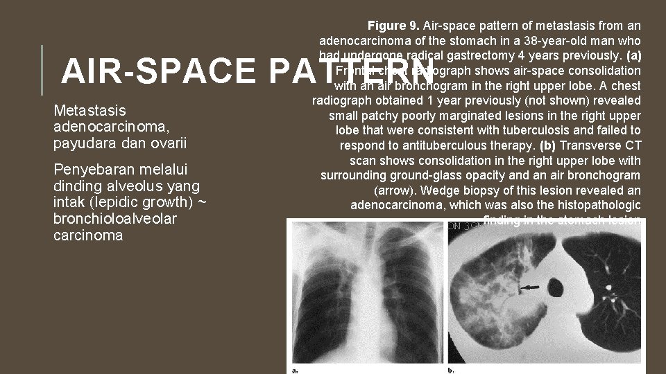 Figure 9. Air-space pattern of metastasis from an adenocarcinoma of the stomach in a