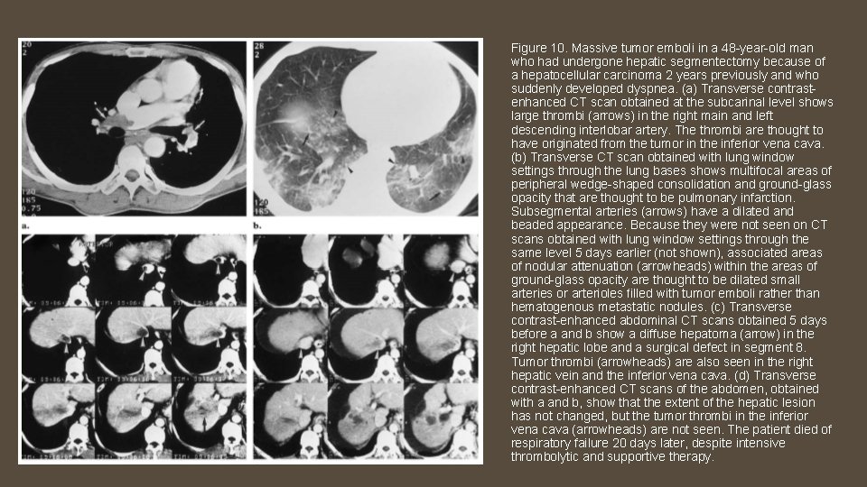 Figure 10. Massive tumor emboli in a 48 -year-old man who had undergone hepatic