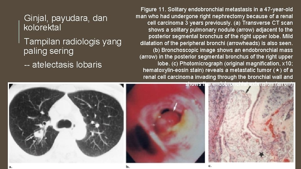 Ginjal, payudara, dan kolorektal Tampilan radiologis yang paling sering -- atelectasis lobaris Figure 11.