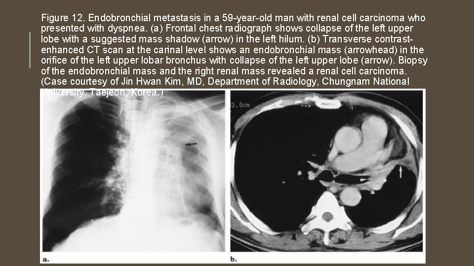 Figure 12. Endobronchial metastasis in a 59 -year-old man with renal cell carcinoma who