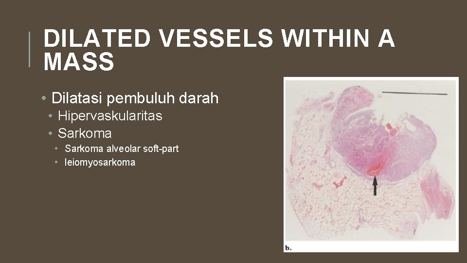 DILATED VESSELS WITHIN A MASS • Dilatasi pembuluh darah • Hipervaskularitas • Sarkoma alveolar