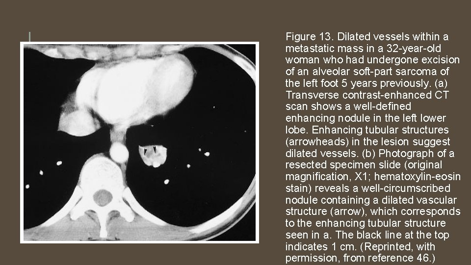 Figure 13. Dilated vessels within a metastatic mass in a 32 -year-old woman who