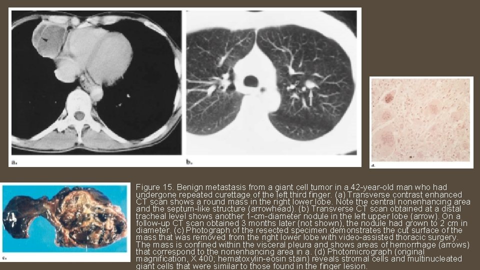 Figure 15. Benign metastasis from a giant cell tumor in a 42 -year-old man