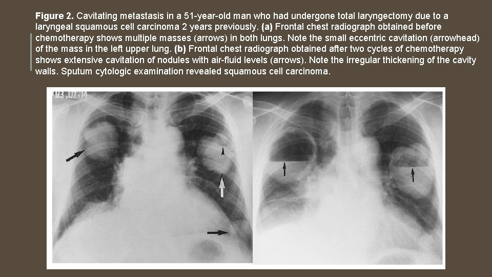 Figure 2. Cavitating metastasis in a 51 -year-old man who had undergone total laryngectomy