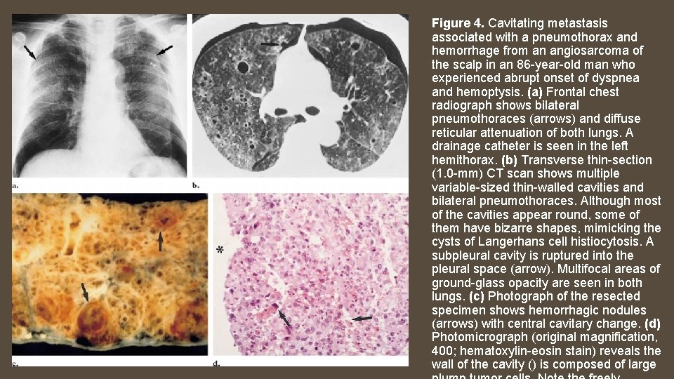 Figure 4. Cavitating metastasis associated with a pneumothorax and hemorrhage from an angiosarcoma of