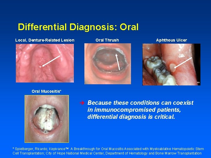 Differential Diagnosis: Oral Local, Denture-Related Lesion Oral Thrush Aphthous Ulcer Oral Mucositis* è Because