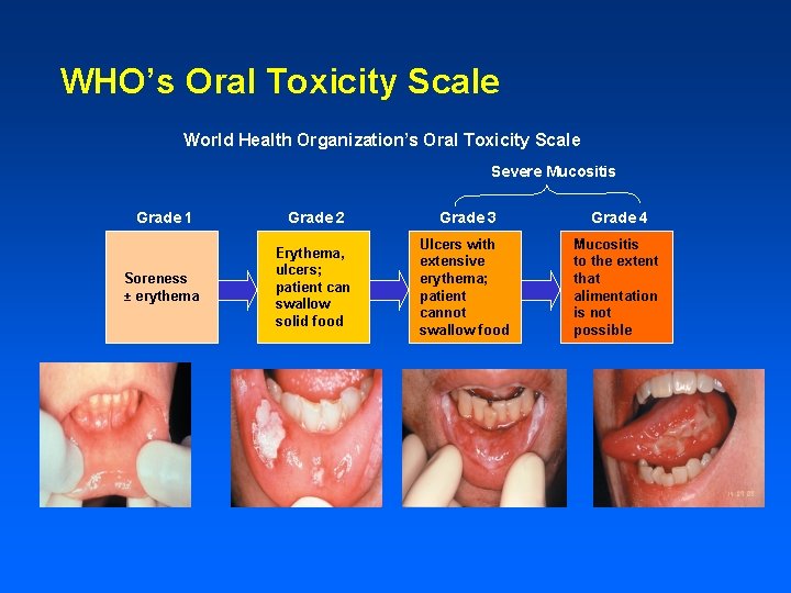 WHO’s Oral Toxicity Scale World Health Organization’s Oral Toxicity Scale Severe Mucositis Grade 1