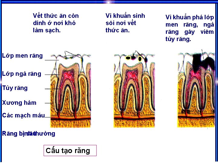 Vết thức ăn còn dính ở nơi khó làm sạch. Lớp men răng Lớp