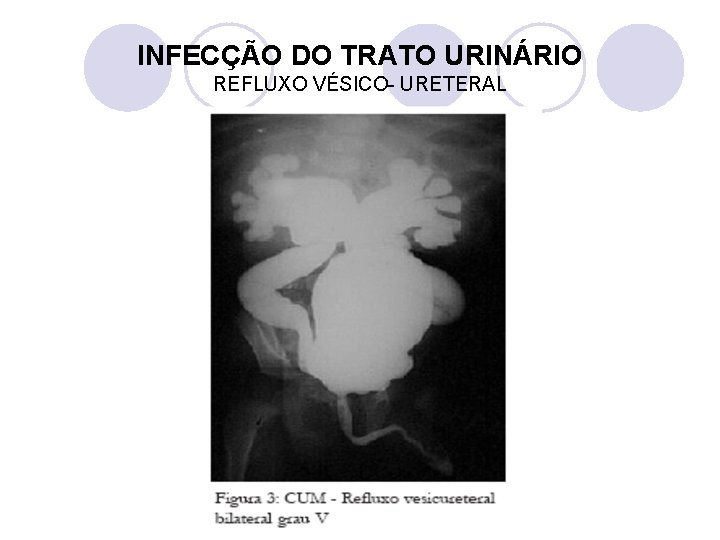 INFECÇÃO DO TRATO URINÁRIO REFLUXO VÉSICO- URETERAL 