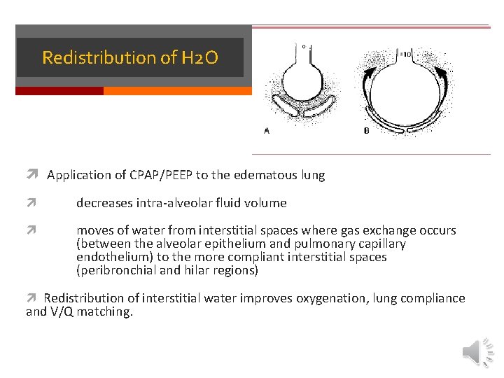 Redistribution of H 2 O Application of CPAP/PEEP to the edematous lung decreases intra-alveolar