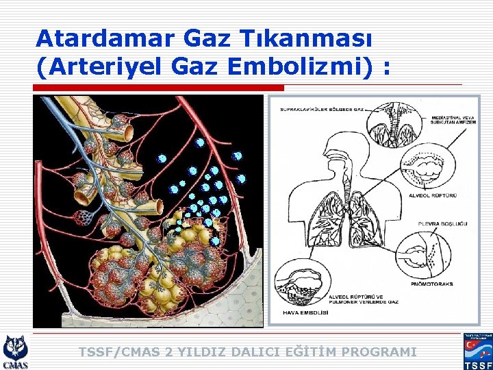 Atardamar Gaz Tıkanması (Arteriyel Gaz Embolizmi) : TSSF/CMAS 2 YILDIZ DALICI EĞİTİM PROGRAMI 