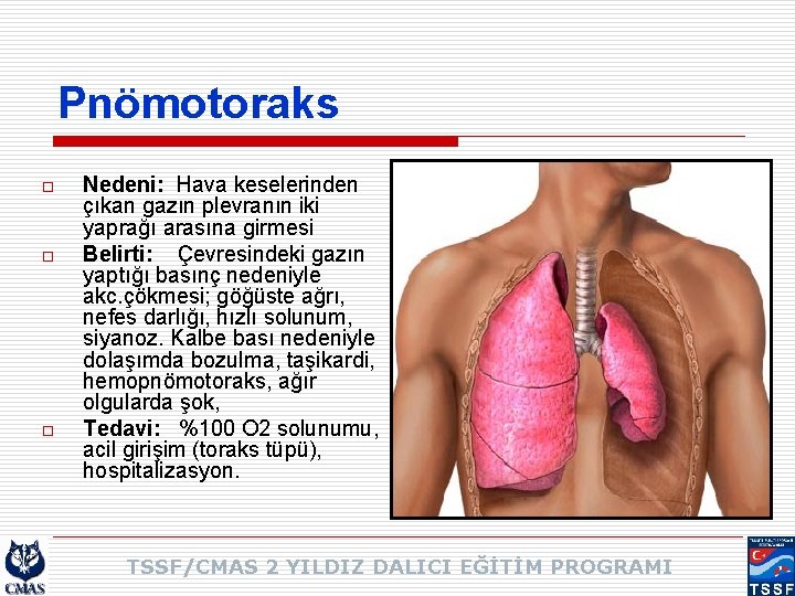 Pnömotoraks o o o Nedeni: Hava keselerinden çıkan gazın plevranın iki yaprağı arasına girmesi