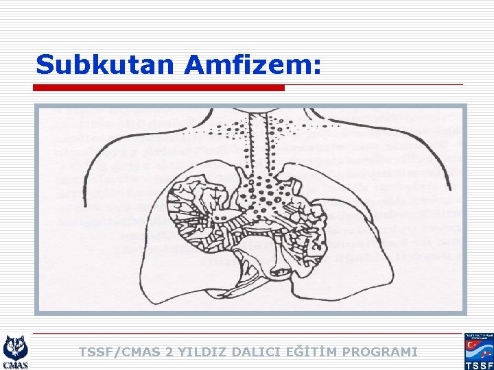 Subkutan Amfizem: TSSF/CMAS 2 YILDIZ DALICI EĞİTİM PROGRAMI 