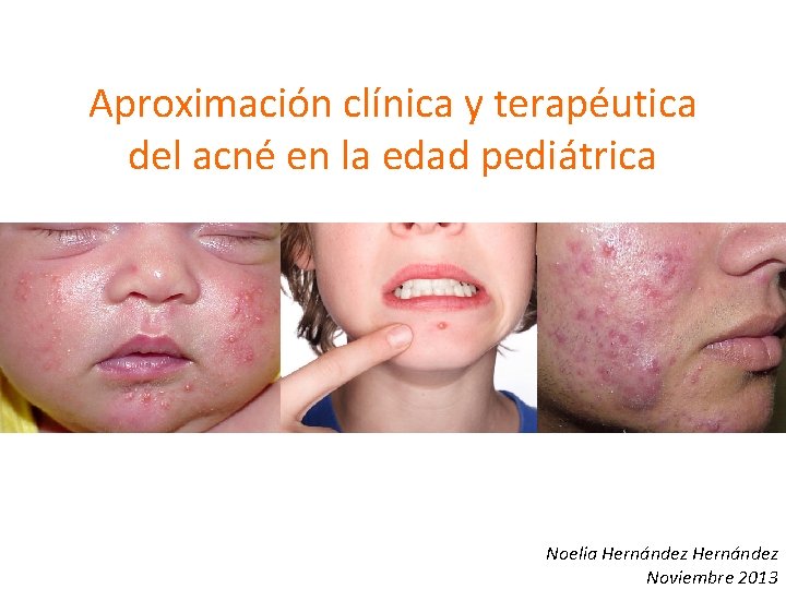 Aproximación clínica y terapéutica del acné en la edad pediátrica Noelia Hernández Noviembre 2013