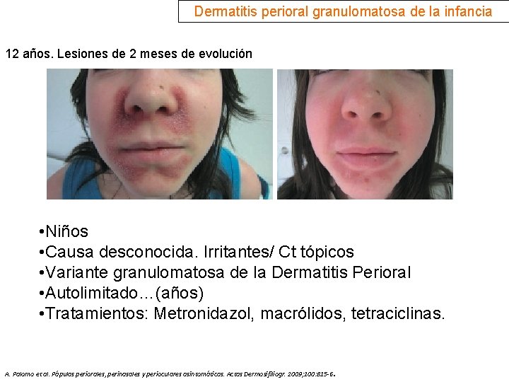 Dermatitis perioral granulomatosa de la infancia 12 años. Lesiones de 2 meses de evolución