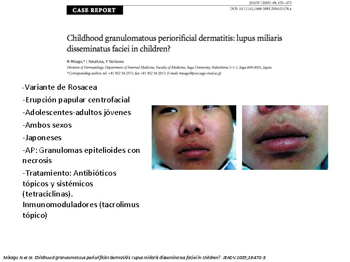 -Variante de Rosacea -Erupción papular centrofacial -Adolescentes-adultos jóvenes -Ambos sexos -Japoneses -AP: Granulomas epitelioides