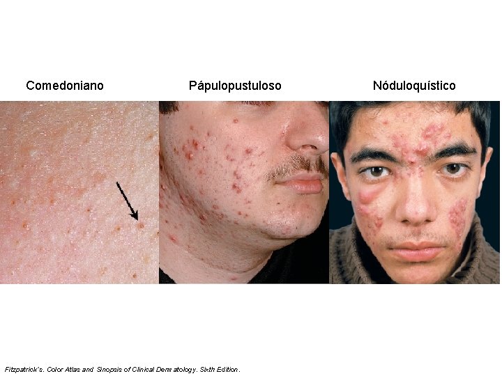 Comedoniano Pápulopustuloso Fitzpatrick´s. Color Atlas and Sinopsis of Clinical Dermatology. Sixth Edition. Nóduloquístico 