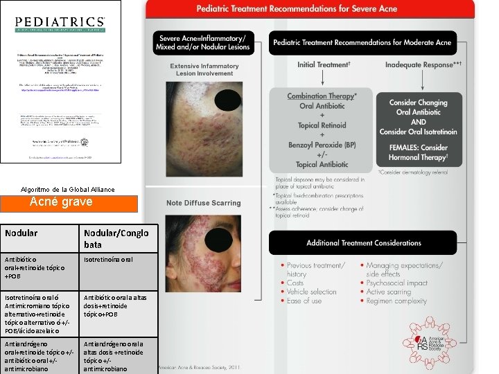 Algoritmo de la Global Alliance Acné grave Nodular/Conglo bata Antibiótico oral+retinoide tópico +POB Isotretinoína