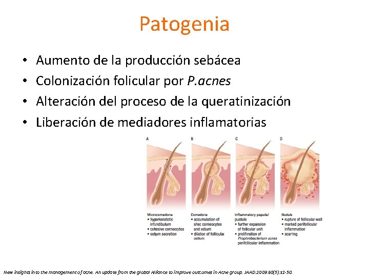 Patogenia • • Aumento de la producción sebácea Colonización folicular por P. acnes Alteración