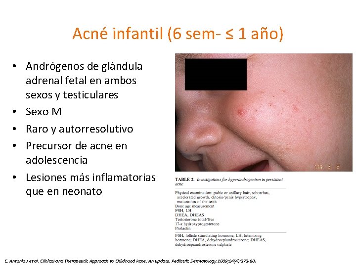 Acné infantil (6 sem- ≤ 1 año) • Andrógenos de glándula adrenal fetal en