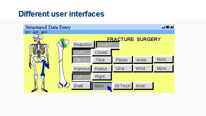 Different user interfaces Structured Data Entry File Edit Help FRACTURE SURGERY Reduction Fixation Open