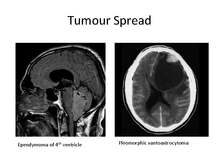 Tumour Spread Ependymoma of 4 th ventricle Pleomorphic xantoastrocytoma 