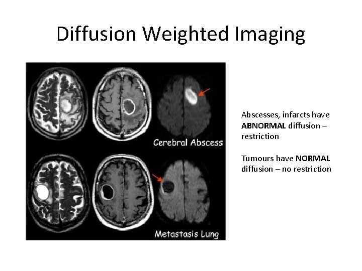 Diffusion Weighted Imaging Abscesses, infarcts have ABNORMAL diffusion – restriction Tumours have NORMAL diffusion