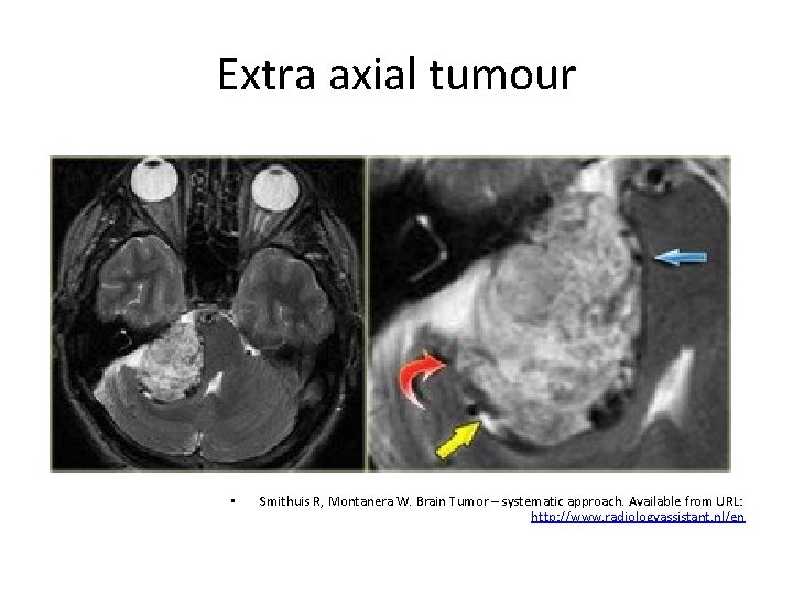 Extra axial tumour • Smithuis R, Montanera W. Brain Tumor – systematic approach. Available