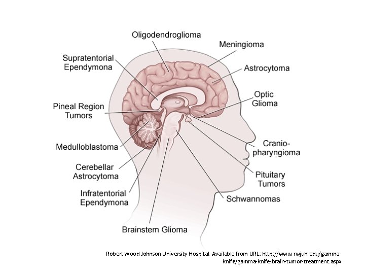 Robert Wood Johnson University Hospital. Available from URL: http: //www. rwjuh. edu/gammaknife/gamma-knife-brain-tumor-treatment. aspx 