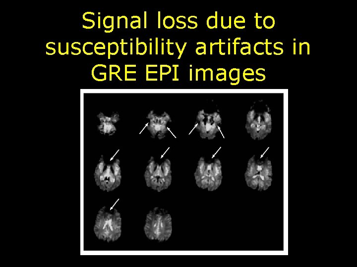 Signal loss due to susceptibility artifacts in GRE EPI images 