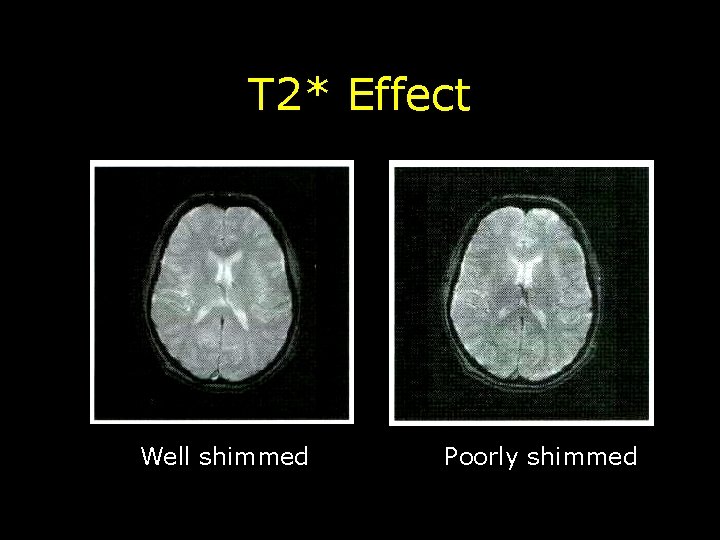 T 2* Effect Well shimmed Poorly shimmed 