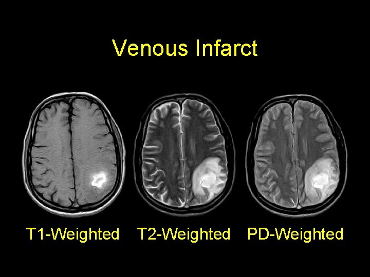 Venous Infarct T 1 -Weighted T 2 -Weighted PD-Weighted 