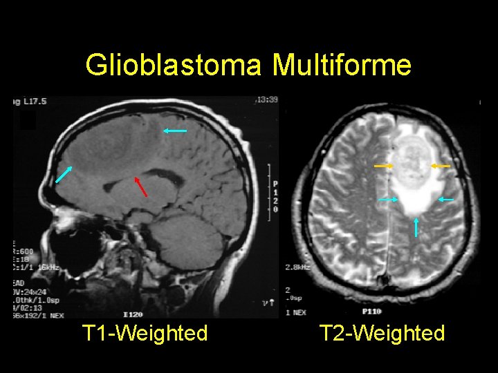 Glioblastoma Multiforme T 1 -Weighted T 2 -Weighted 