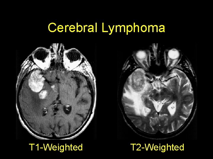 Cerebral Lymphoma T 1 -Weighted T 2 -Weighted 