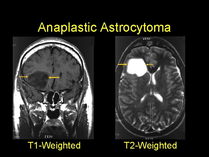 Anaplastic Astrocytoma T 1 -Weighted T 2 -Weighted 