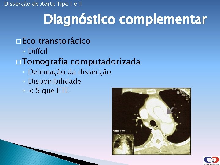 Dissecção de Aorta Tipo I e II Diagnóstico complementar � Eco transtorácico ◦ Difícil