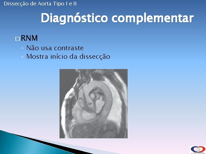 Dissecção de Aorta Tipo I e II Diagnóstico complementar � RNM ◦ Não usa