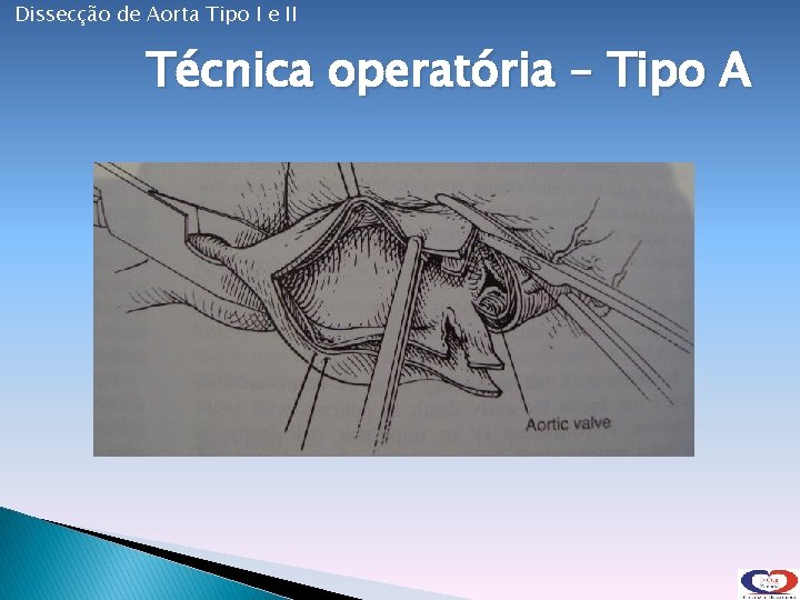 Dissecção de Aorta Tipo I e II Técnica operatória – Tipo A 