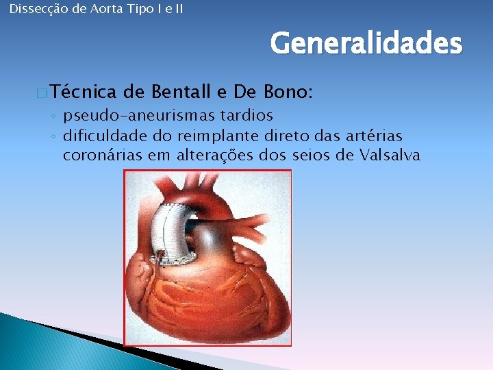 Dissecção de Aorta Tipo I e II Generalidades � Técnica de Bentall e De