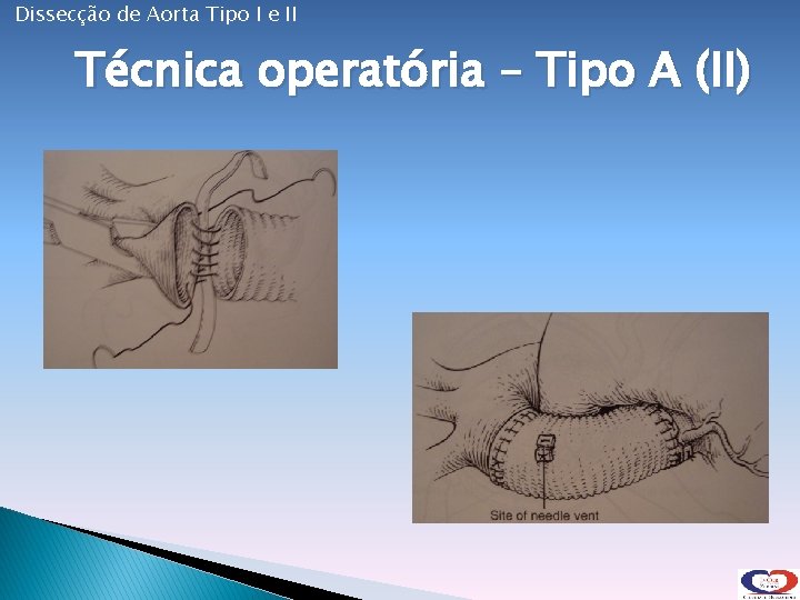 Dissecção de Aorta Tipo I e II Técnica operatória – Tipo A (II) 