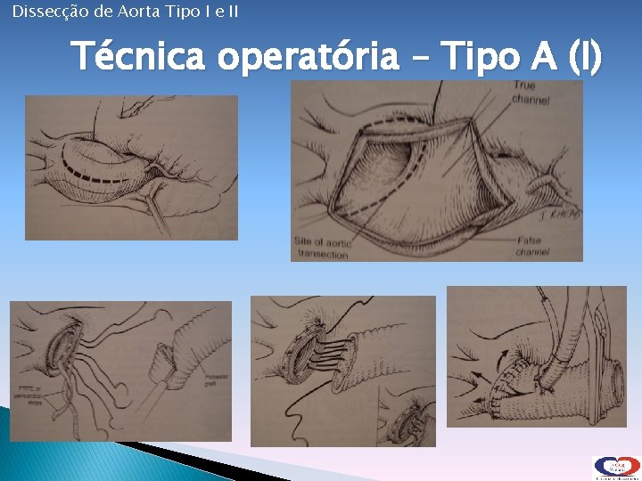 Dissecção de Aorta Tipo I e II Técnica operatória – Tipo A (I) 