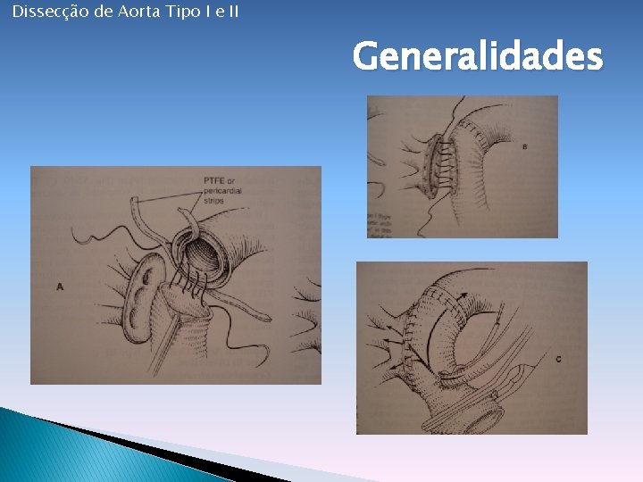 Dissecção de Aorta Tipo I e II Generalidades 