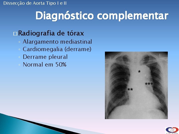 Dissecção de Aorta Tipo I e II Diagnóstico complementar � Radiografia ◦ ◦ de