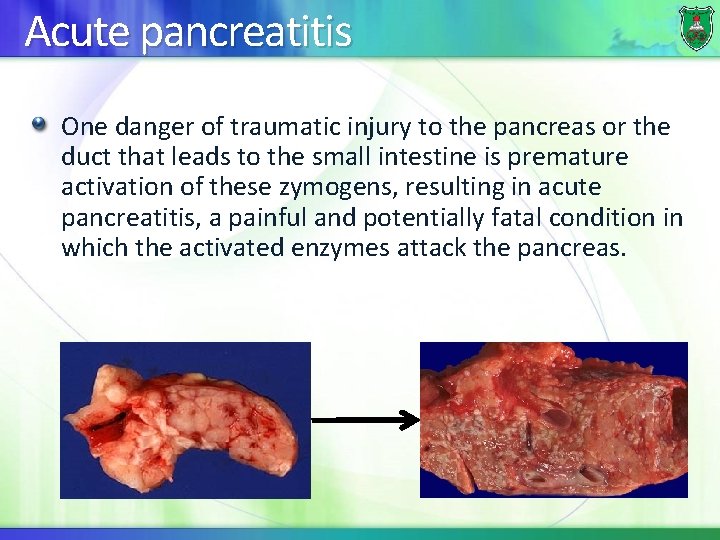 Acute pancreatitis One danger of traumatic injury to the pancreas or the duct that