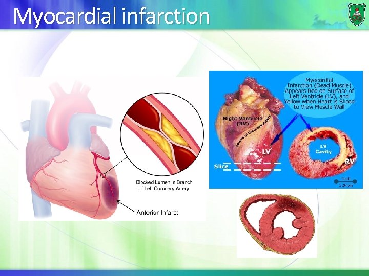 Myocardial infarction 