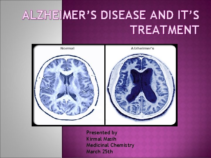 ALZHEIMER’S DISEASE AND IT’S TREATMENT Presented by Kirmal Masih Medicinal Chemistry March 25 th