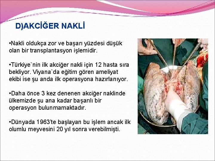 D)AKCİĞER NAKLİ • Nakli oldukça zor ve başarı yüzdesi düşük olan bir transplantasyon işlemidir.