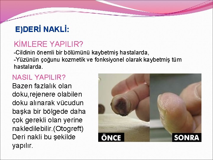 E)DERİ NAKLİ: KİMLERE YAPILIR? -Cildinin önemli bir bölümünü kaybetmiş hastalarda, -Yüzünün çoğunu kozmetik ve